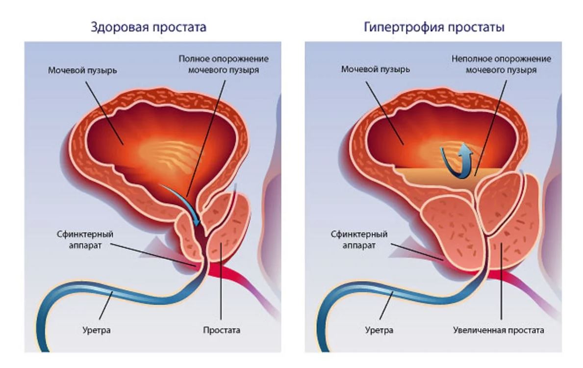 Гипертрофия предстательной железы