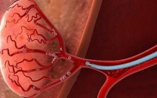 Эмболизация артерий предстательной железы (ЭАП): что такое и как проводится