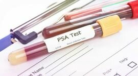 Простата специфический антиген (ПСА): как правильно сдать кровь