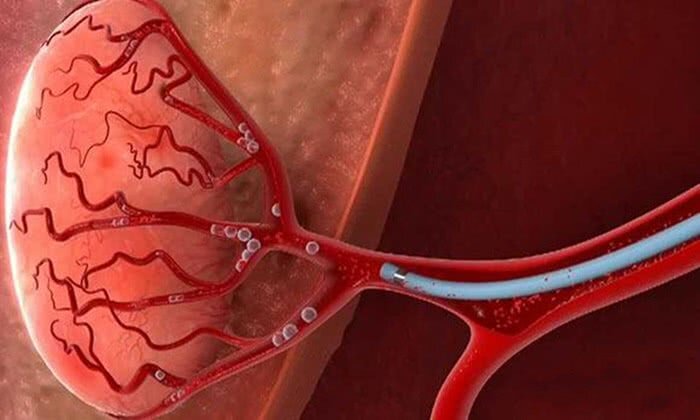 Эмболизация артерий предстательной железы (ЭАП): что такое и как проводится